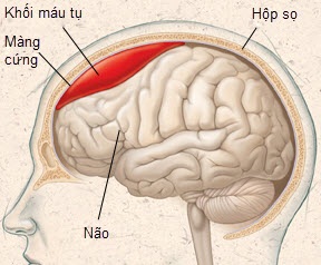 Bạn biết gì về đột quỵ não giả?